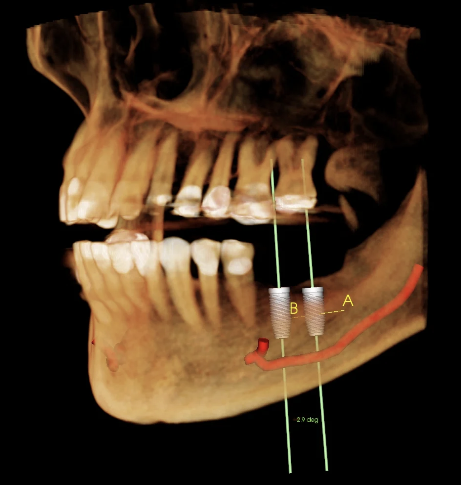 Cone Beam CT (CBCT) scan used for precise dental implant planning and placement at Jeffrey L. Cohen, DDS in Covina, CA.