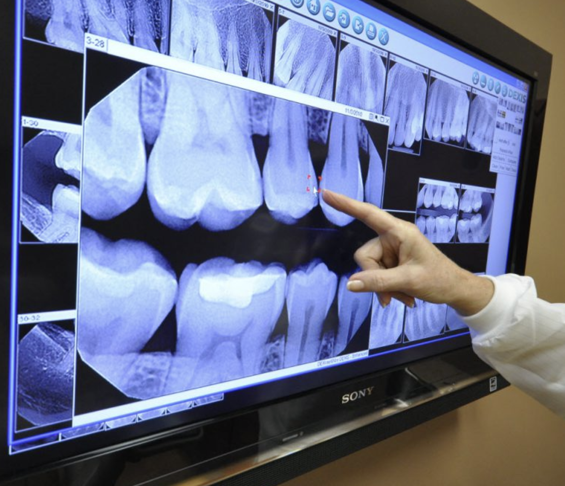 Digital dental X-rays help detect cavities, infections, bone loss, and other oral health problems during a comprehensive dental exam at Jeffrey L. Cohen, DDS in Covina, CA.