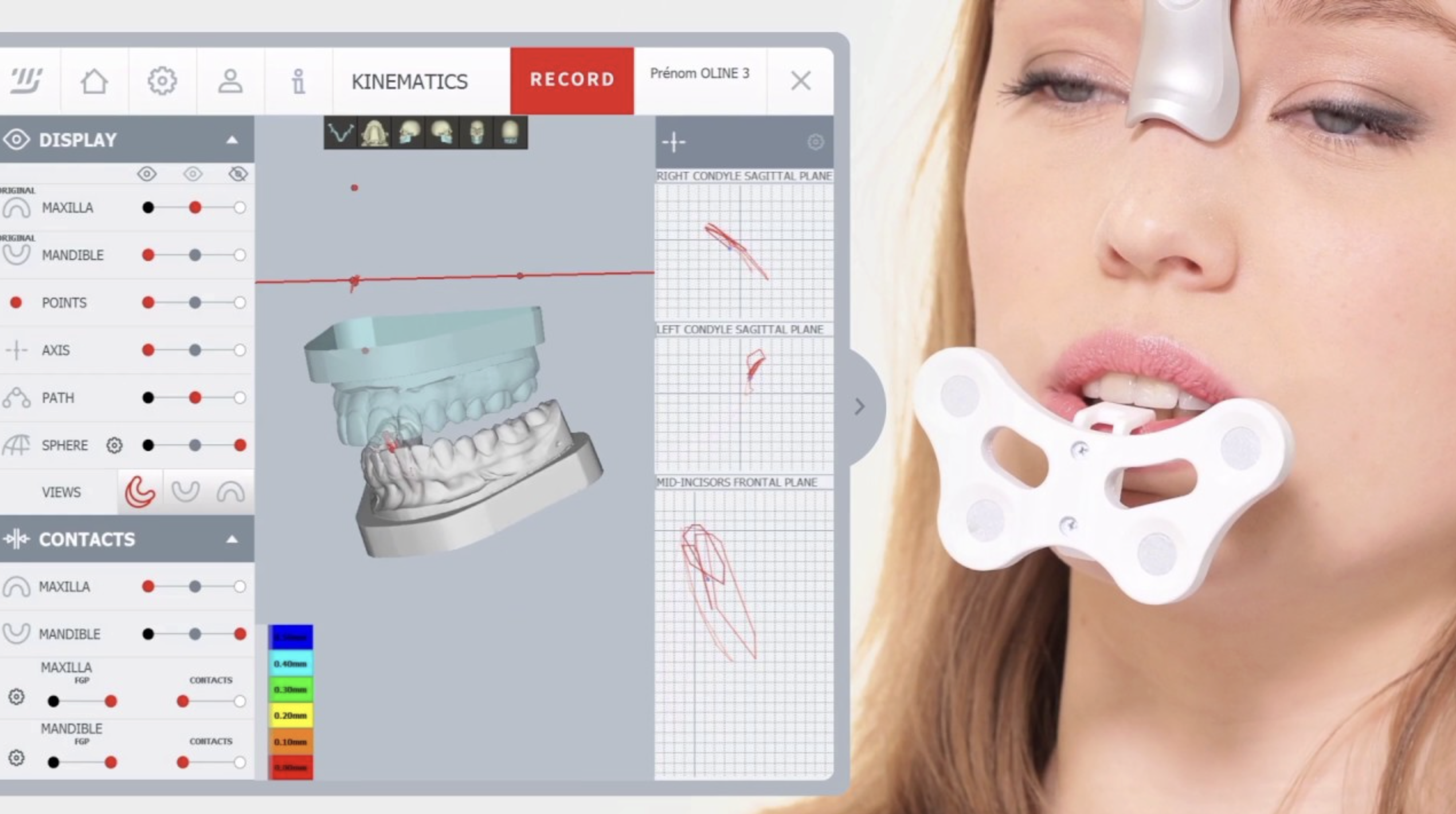 MODJAW digital jaw tracking system analyzing jaw movement for TMJ diagnosis, bite analysis, and restorative dentistry at Jeffrey L. Cohen, DDS in Covina, CA.